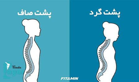 آیا میدانید چگونه قوز کمر رو از بین ببریم