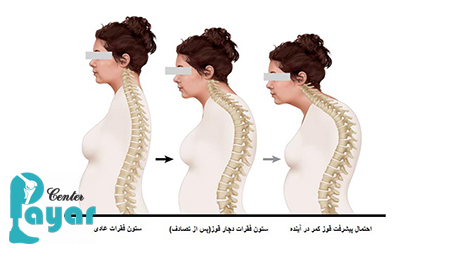 انواع کیفوز
