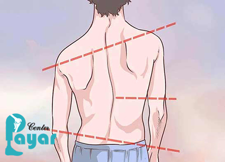 تعیین درجه اسکولیوز