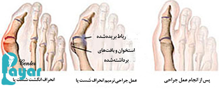 در مورد درمان قطعی هالوکس والگوس چه میدانید؟