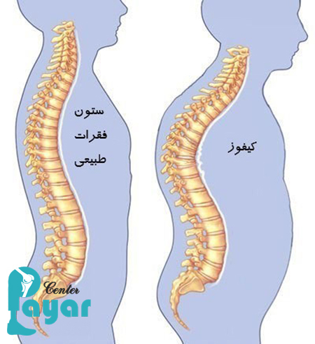 علت کیفوز چیست؟ در مورد علت بروز انواع کیفوز چه میدانید؟