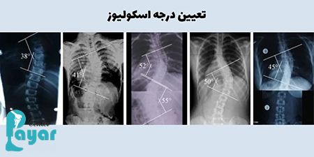 چگونه تعیین درجه اسکولیوز امکان پذیر است؟