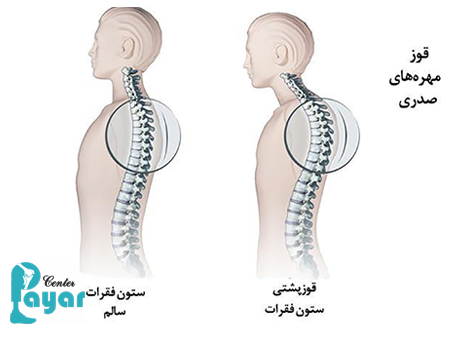 درمان انواع کیفوز