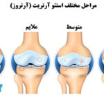 استئوآرتریت چیست؟⭐هر آنچه از استئوآرتریت باید بدانید