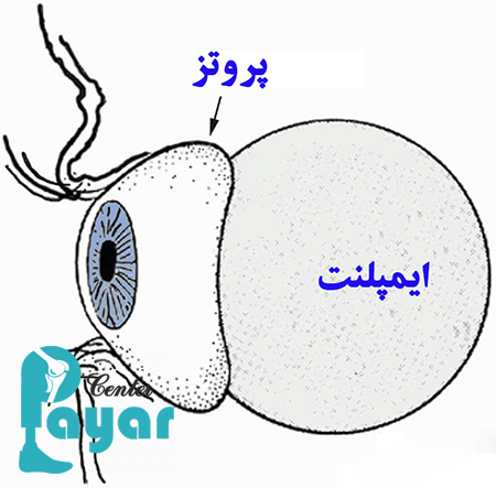 پروتز چشم متحرک چیست؟ برای ساخت پروتز چشم متحرک چه کنیم؟