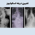 چگونه تعیین درجه اسکولیوز امکان پذیر است؟