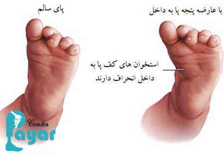 با حرکات اصلاحی چرخش مچ پا به داخل اشنا شوید