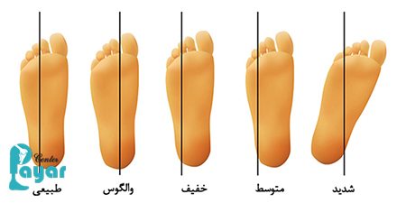 در مورد حرکات اصلاحی چرخش مچ پا به داخل چه میدانید