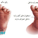 حرکات اصلاحی چرخش مچ پا به داخل⭐(4حرکت اصلاحی)