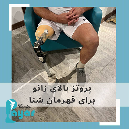 ساخت پروتز بالای زانو در کلینیک پایار