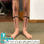 چرخش مچ پا به خارج چیست؟⭐علت و درمان چرخش مچ پا به خارج