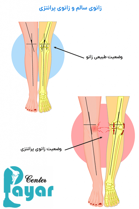 اصلاح زانوی پرانتزی با ارتز به چه شکل است