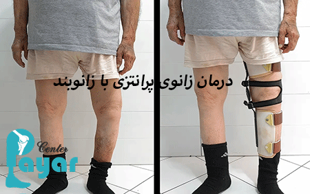 اصلاح زانوی پرانتزی با ارتز