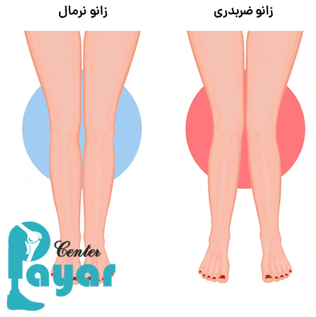 درمان زانوی ضربدری با جراحی