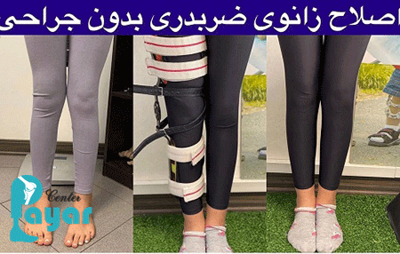 درمان زانوی ضربدری