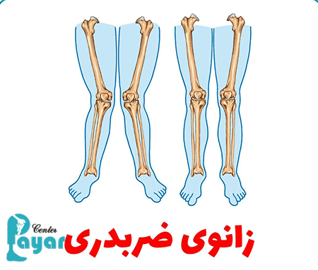 در مورد علت زانوی ضربدری چه میدانید