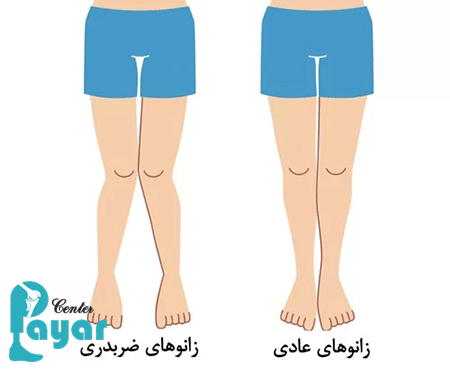 در مورد عوارض زانوی ضربدری چه میدانید