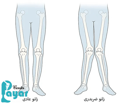 علت زانوی ضربدری چیست