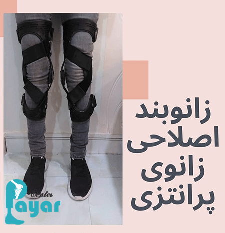 فواید اصلاح زانوی پرانتزی با ارتز