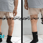 اصلاح زانوی پرانتزی با ارتز ⭐بریس طبی زانو