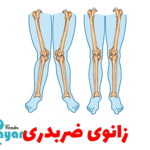 علت زانوی ضربدری چیست؟⭐آن را جدی بگیرید