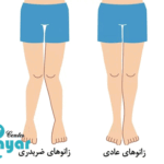 عوارض زانوی ضربدری چیست؟⭐آن را جدی بگیرید