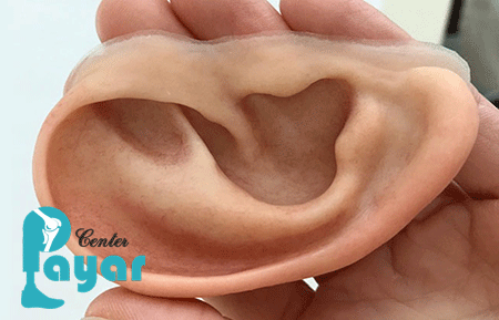 انواع پروتز گوش چیست