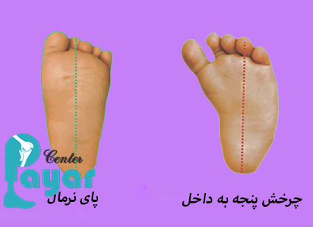 از کجا متوجه شویم که کودکان به کفش طبی پنجه برعکس نیاز دارد؟