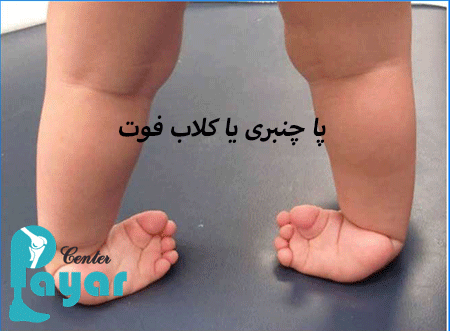 درمان کلاب فوت بدون جراحی چگونه است