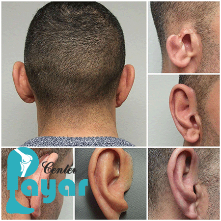 مزایای نصب پروتز گوش چیست