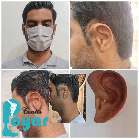 مزیت های پروتز گوش چیست