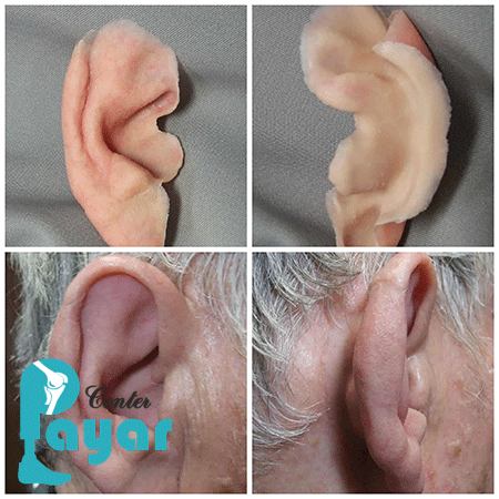 پروتز گوش چیست