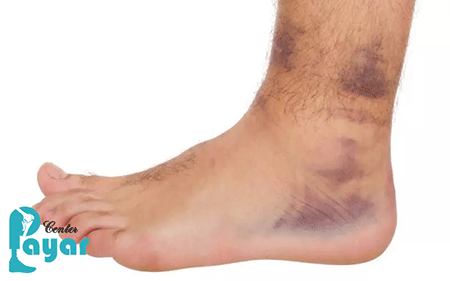 علائم پیچ خوردگی مچ پا چیست