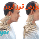 عوارض قوز گردن چیست؟🌟آن را جدی بگیرید