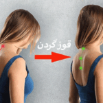 قوز گردن چیست؟🌟هر آنچه که باید بدانید