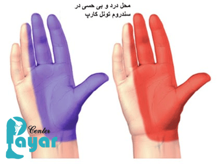 آیا میدانید سندروم تونل کارپال چیست