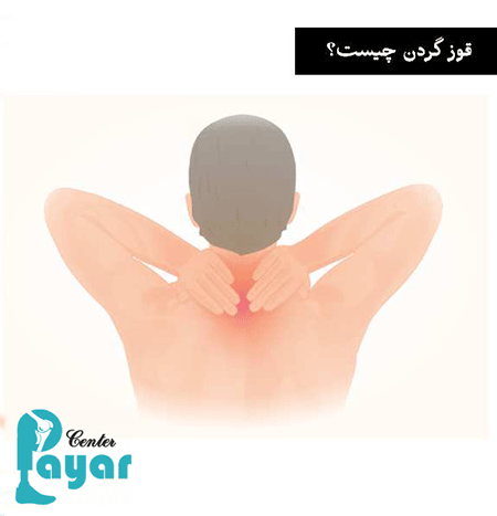 در مورد اینکه آیا قوز گردن درمان میشود چه می دانید