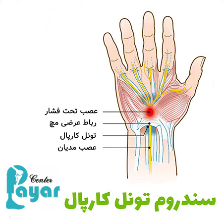 سندروم تونل کارپال چیست