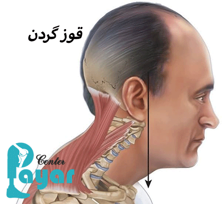 علائم قوز گردن