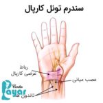 علائم سندروم تونل کارپال چیست؟🌟پیشگیری کنید