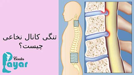 در مورد اگر تنگی کانال نخاعی درمان نشود چه میشود چه میدانید