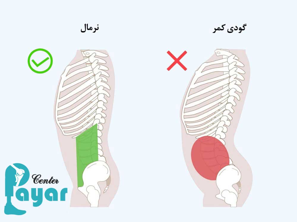 علت لوردوز چیست