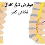 تنگی کانال نخاعی چه عوارضی دارد؟🌟عوارض تنگی کانال نخاعی